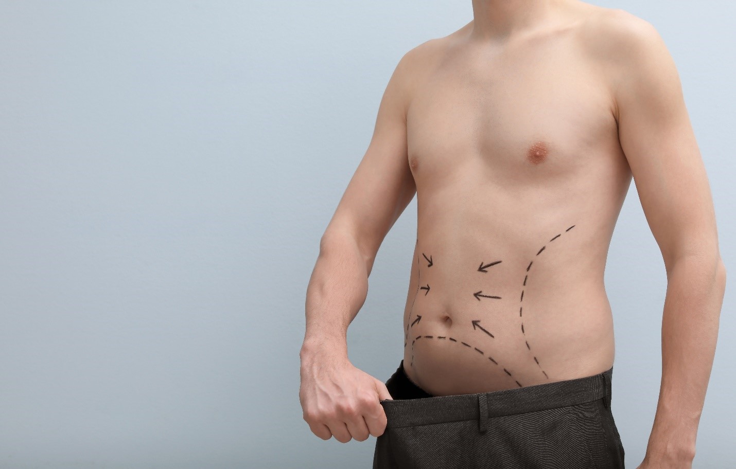 Liposucción: ¿Es la opción perfecta para ti? Descubre los increíbles beneficios y los riesgos que debes tener en cuenta
