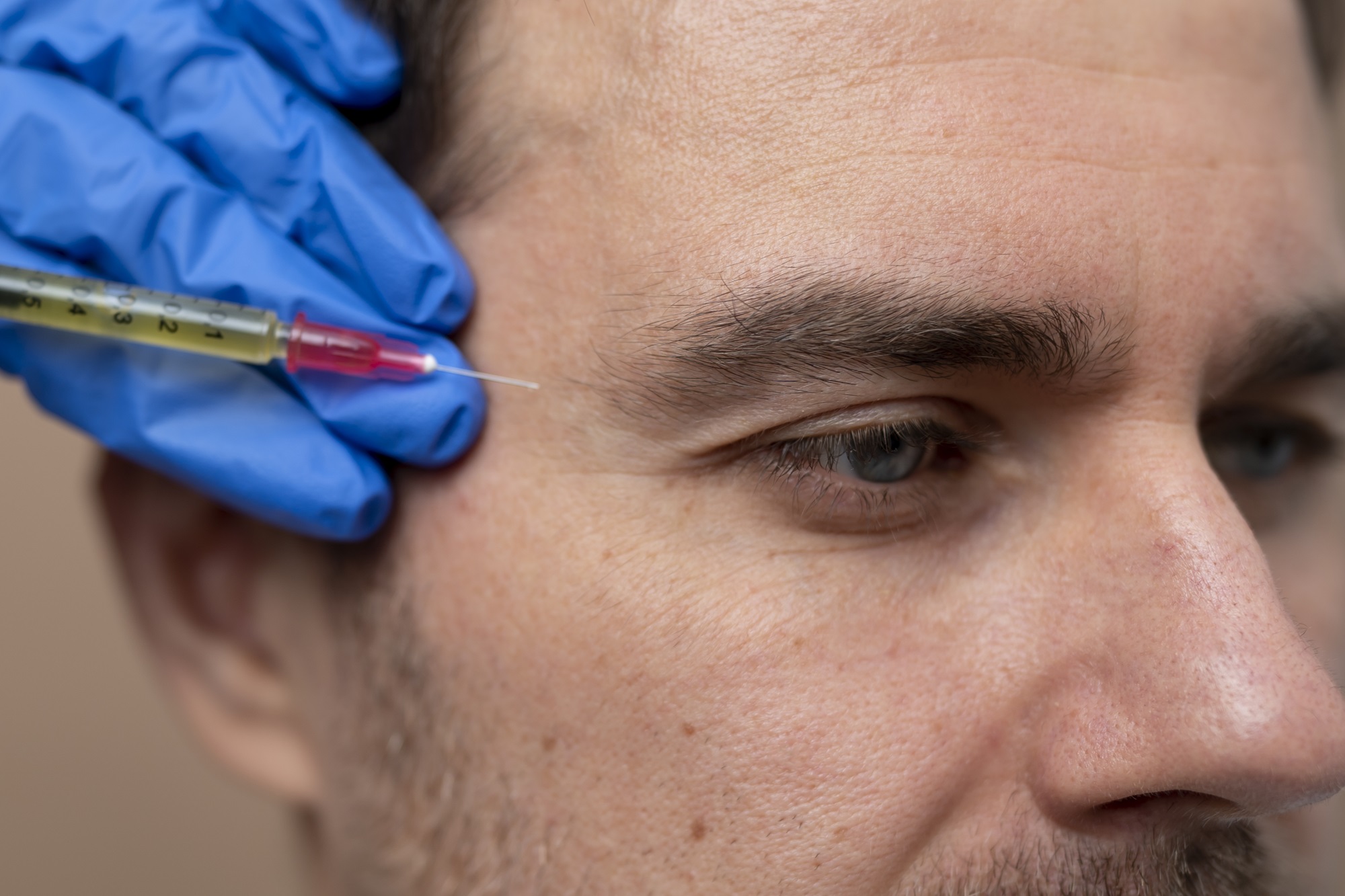 5 increíbles beneficios del botox preventivo para mantener una piel joven y radiante
