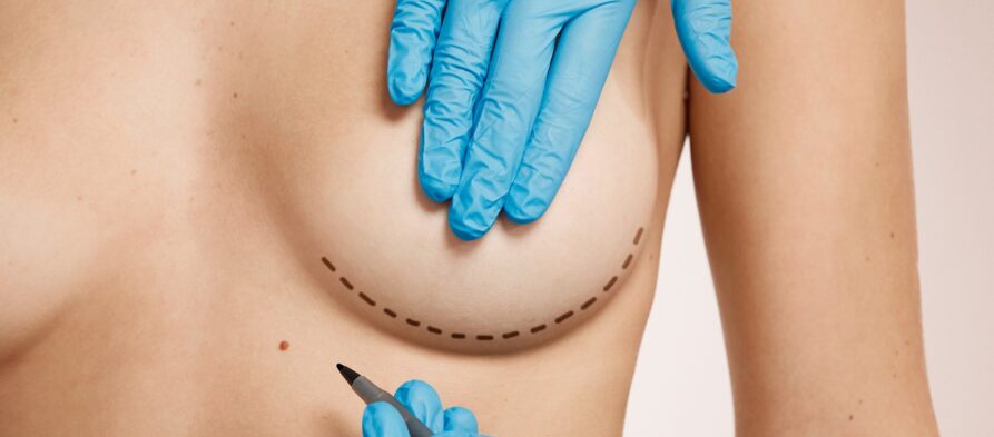 mamoplastia