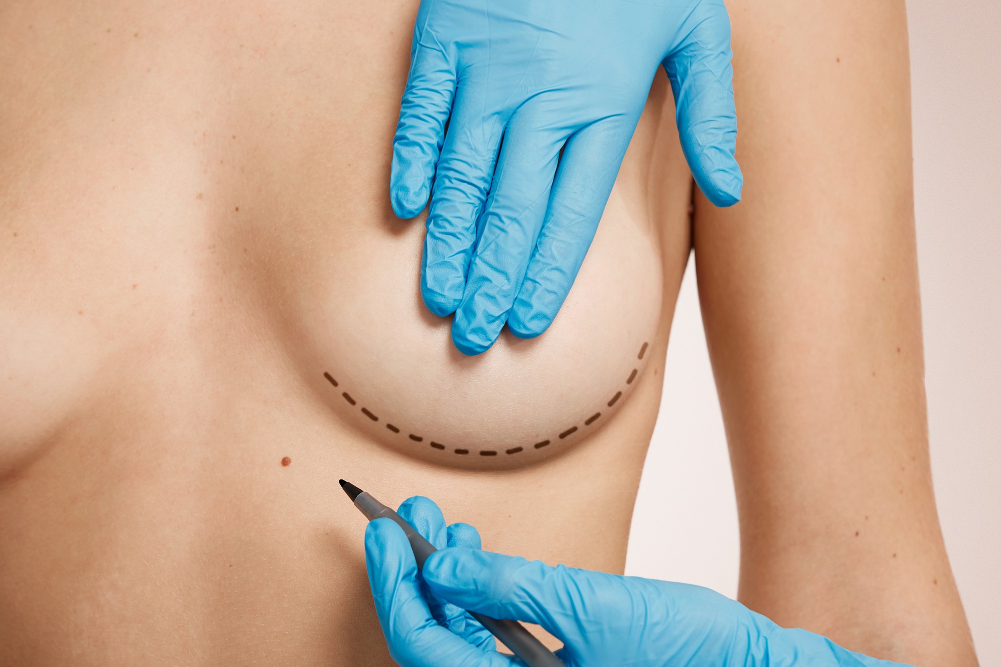 Transforma tu silueta: 7 claves esenciales sobre la mamoplastia